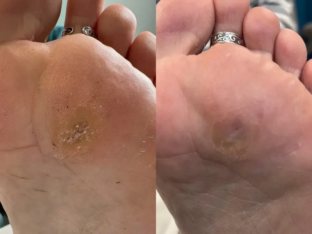 LR Podiatry Sheffield swift before and after.jpg