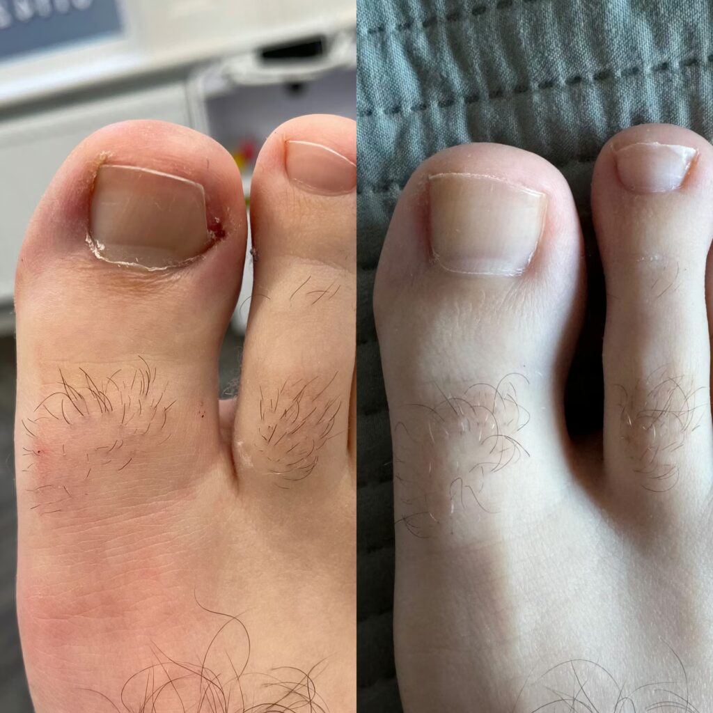 LRPodiatry Sheffield before and after ingrowing toenail