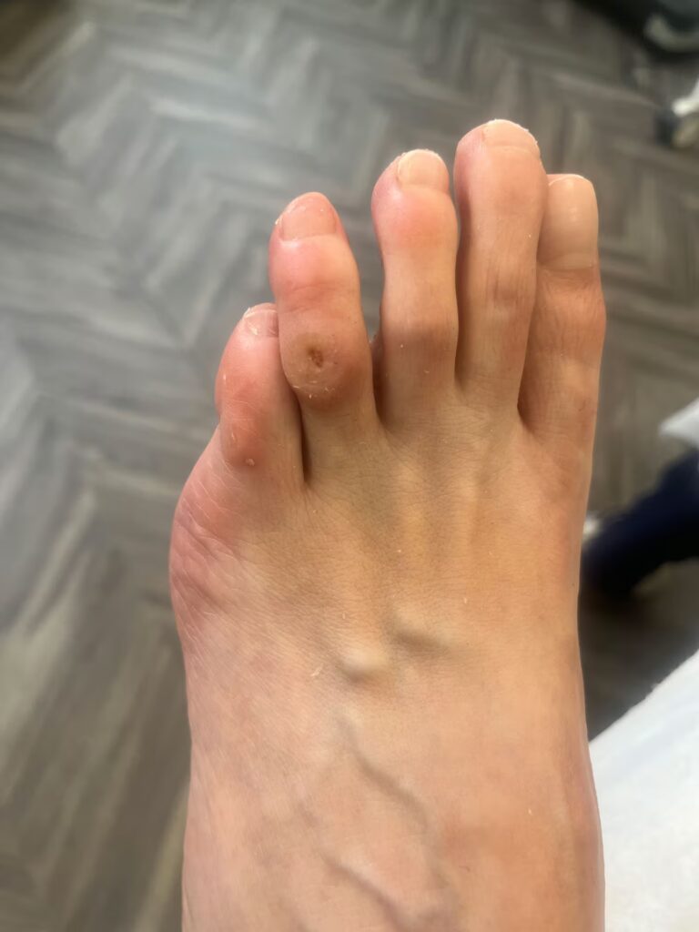 LRPodiatry Sheffield corn on toe