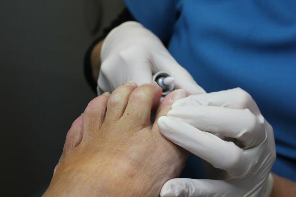 Nail Surgery 3 LRPodiatry Sheffield nail care