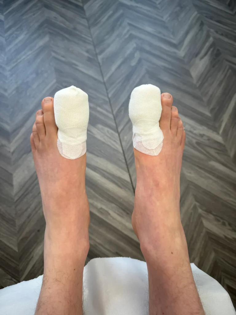 LRPodiatry Sheffield post surgery dressings