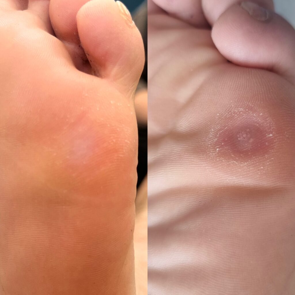 LRPodiatry Sheffield verruca needling before and after