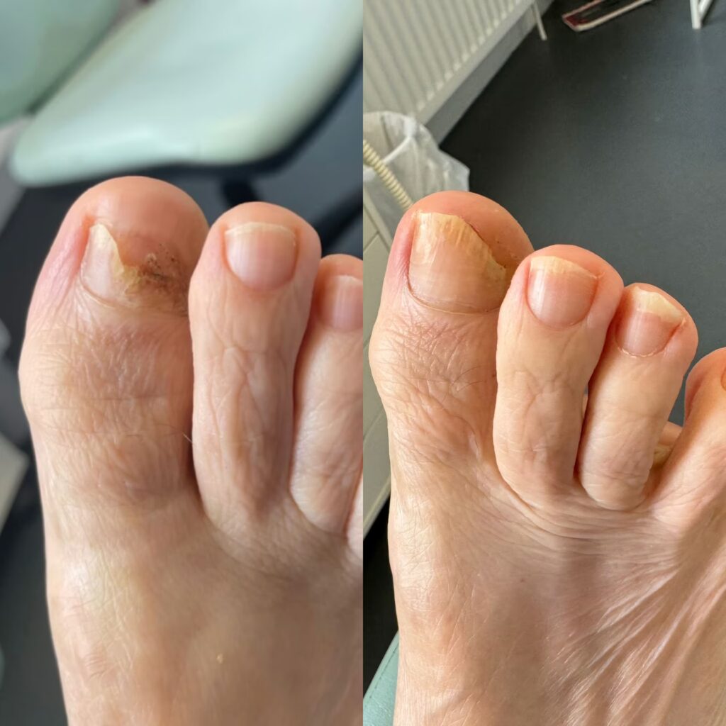 Nail Reconstruction