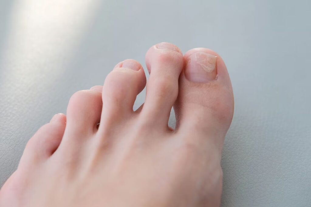 a close up of a foot with a fungus on the nails 2025 01 07 23 20 30 utc