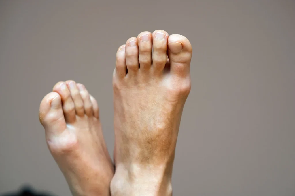 bunions feet