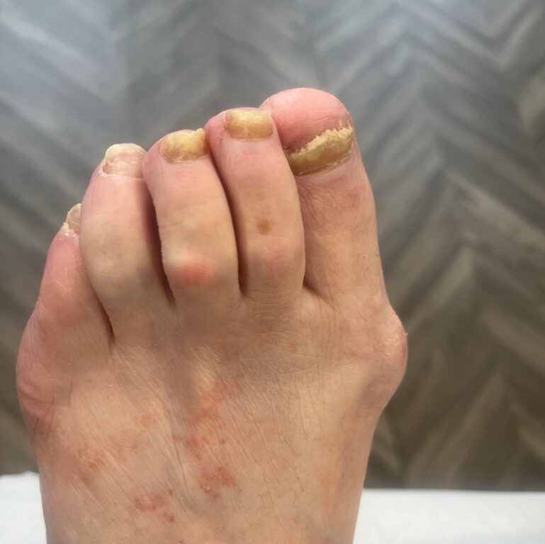 Toe nails with a fungal infection