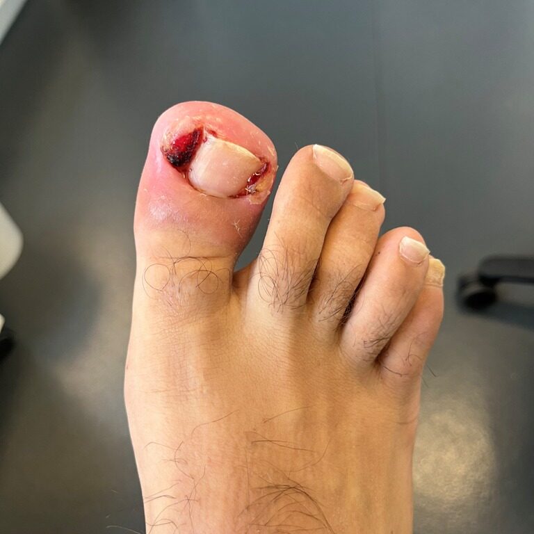 A foot with an ingrowing toenail