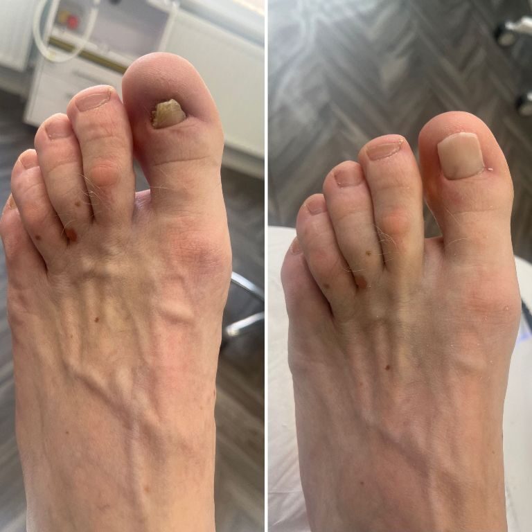 A big toe nail before and after nail reconstruction